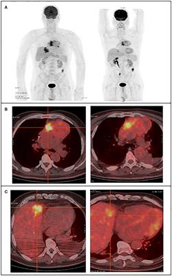 Next-Generation Sequencing at High Sequencing Depth as a Tool to Study the Evolution of Metastasis Driven by Genetic Change Events of Lung Squamous Cell Carcinoma